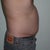 SmartLipo MPX Community Photo